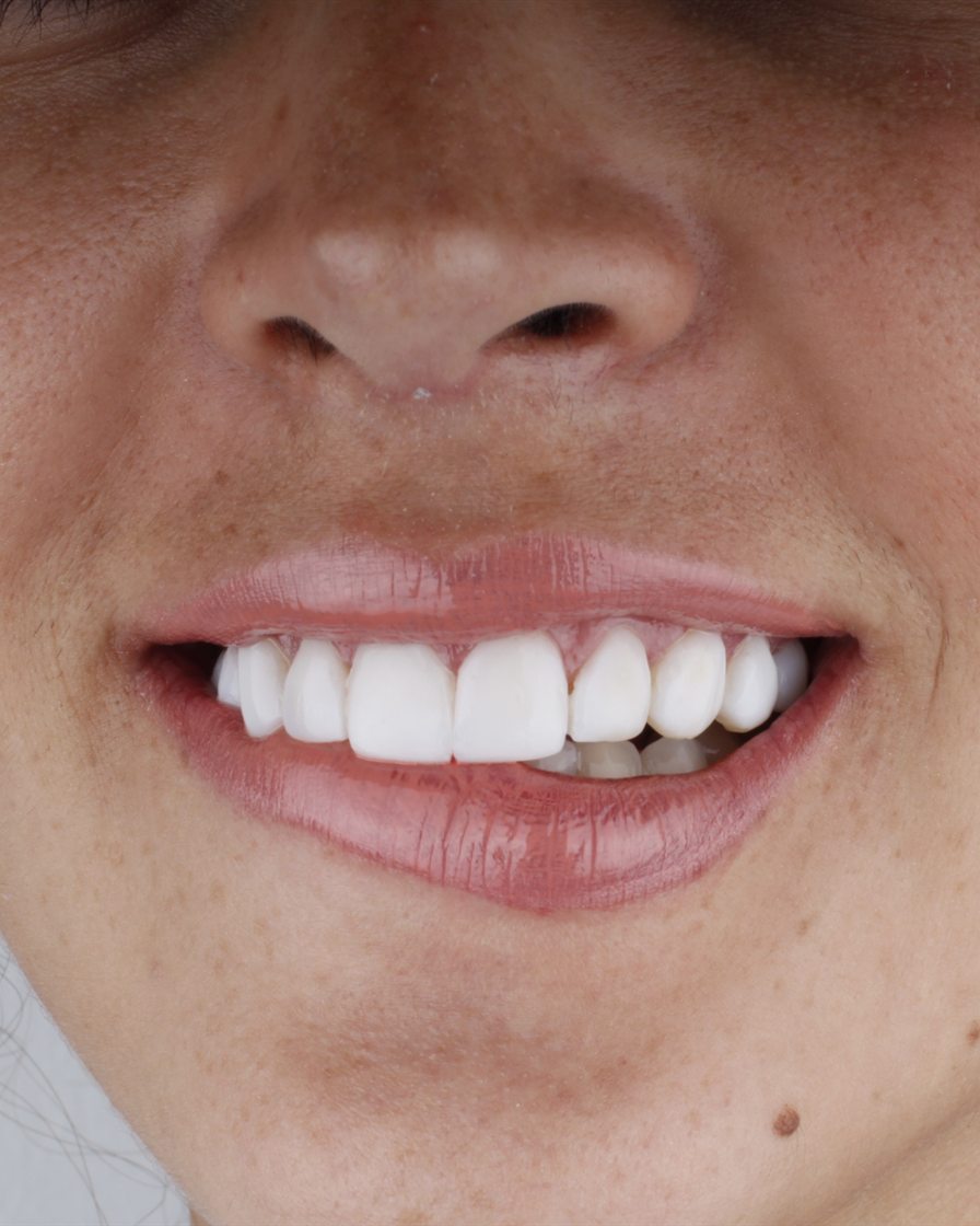 Sonrisa de una paciente de nuestra clínica de Gaithersburg